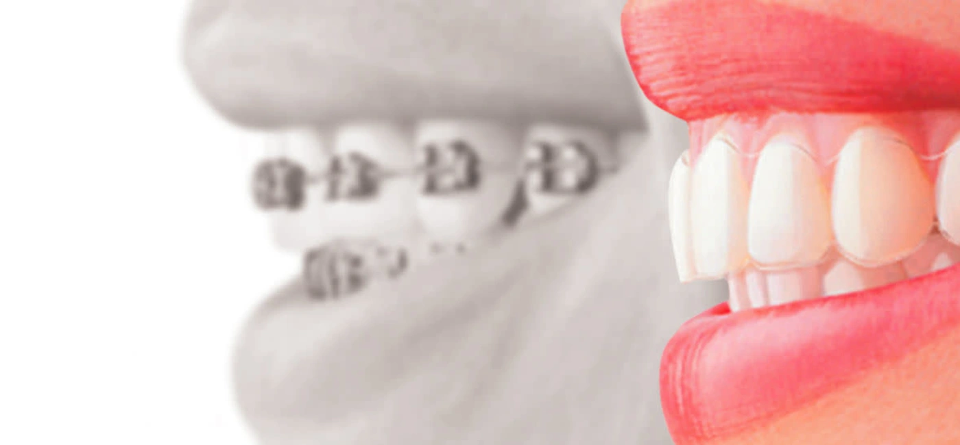 Illustration d’un traitement orthodontique